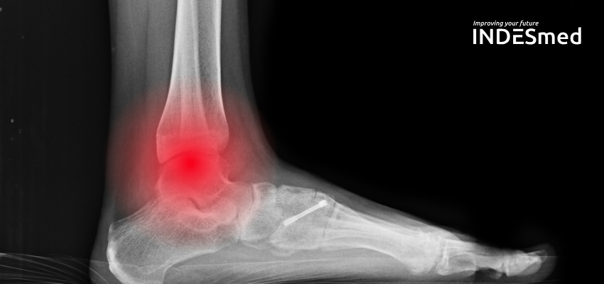 Pourquoi ma fracture me fait mal la nuit ?